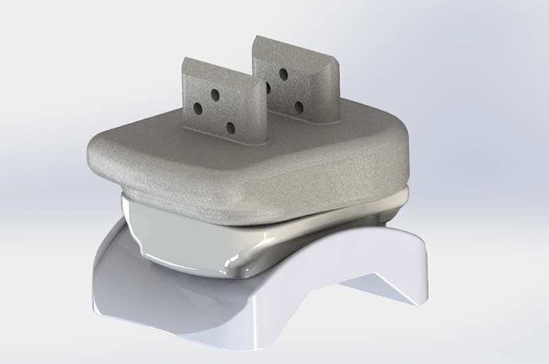 The ankle replacement device developed by College of Engineering Professor Sorin Siegler, PhD, and the Drexel start-up company Kinos Medical led by Drexel alumnus Brian Garvey. 