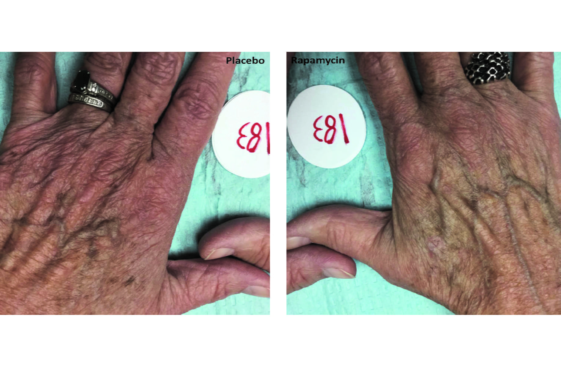 Hand treated with rapymycin alongside placebo untreated hand
