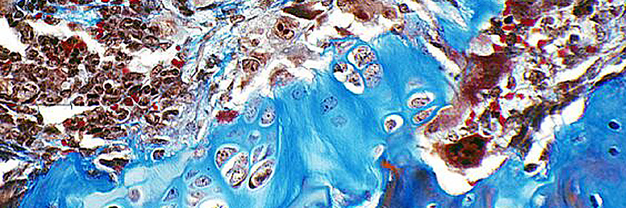 Bone invasion image from the Alessandro Fatatis Research Laboratory.