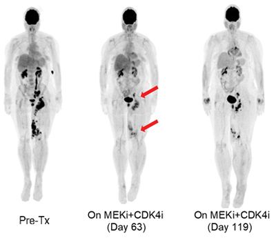 Patient relapse. The role of tumor suppressors in cancer drug resistance. Source: Romano Lab