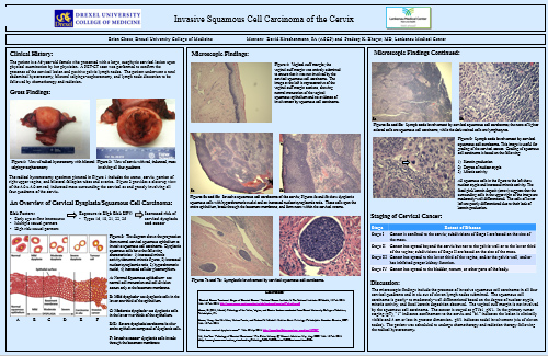 Invasive Squamous Cell Carcinoma of the Cervix