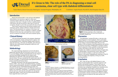 The role of the PA in diagnosing a renal cell carcinoma, clear cell type with rhabdoid differentiation