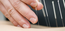 Acupuncture