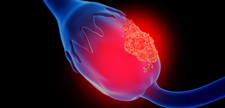 Ovarian cancer concept.