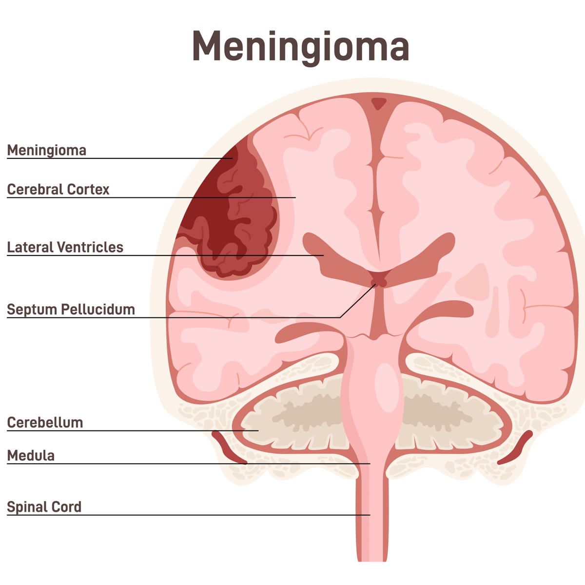 Meningioma